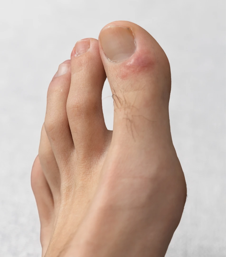 Miami, FL Ingrown Nail Removal Banner