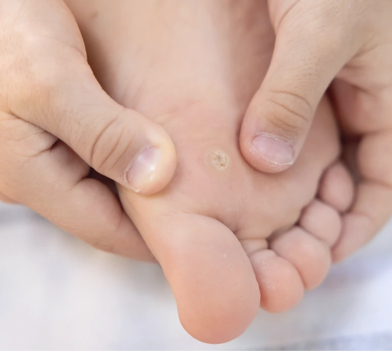 Corns & Calluses Treatment in Miami, FL Banner
