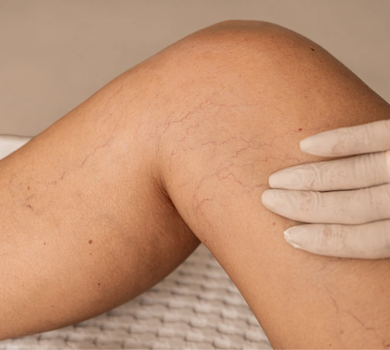 Best Vein Treatment in Miami, Florida Banner
