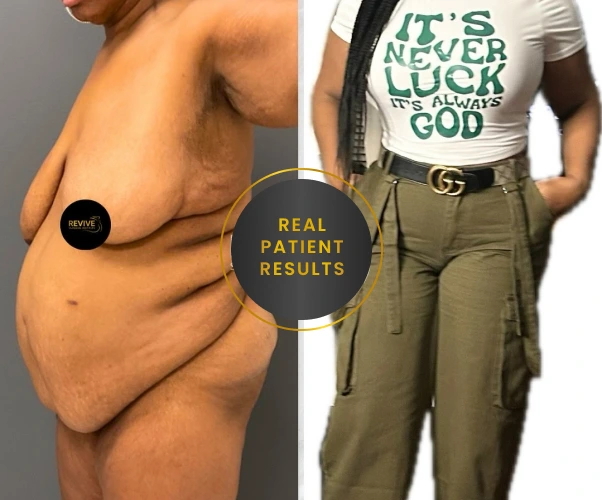 Consultation Preparation for fleur de lis tummy tuck