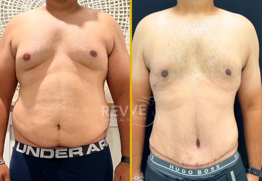 Male-TT-back-lipo-gyne-a