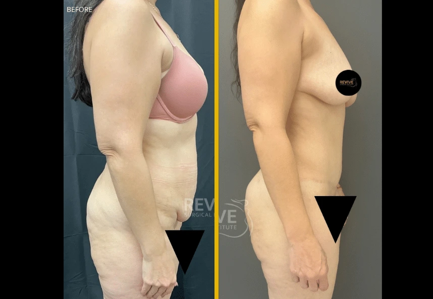 Revive-XLift-2.2