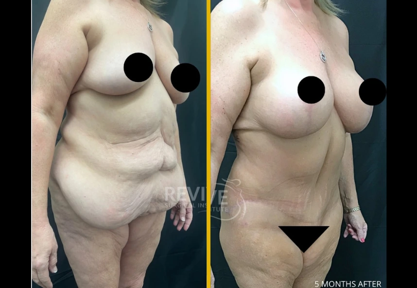 Before and after X-lift at 5 months showing breast and torso lift results