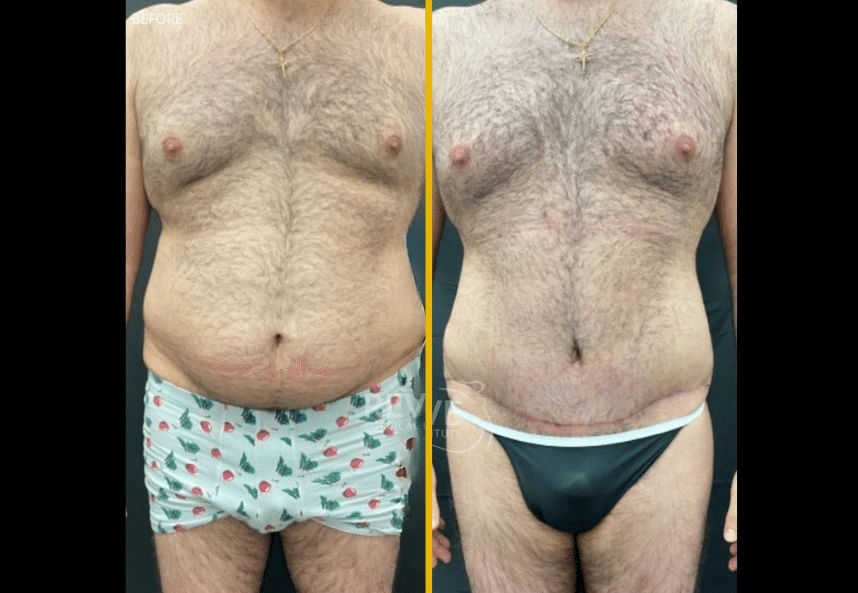 Tummy-Tuck-BBL