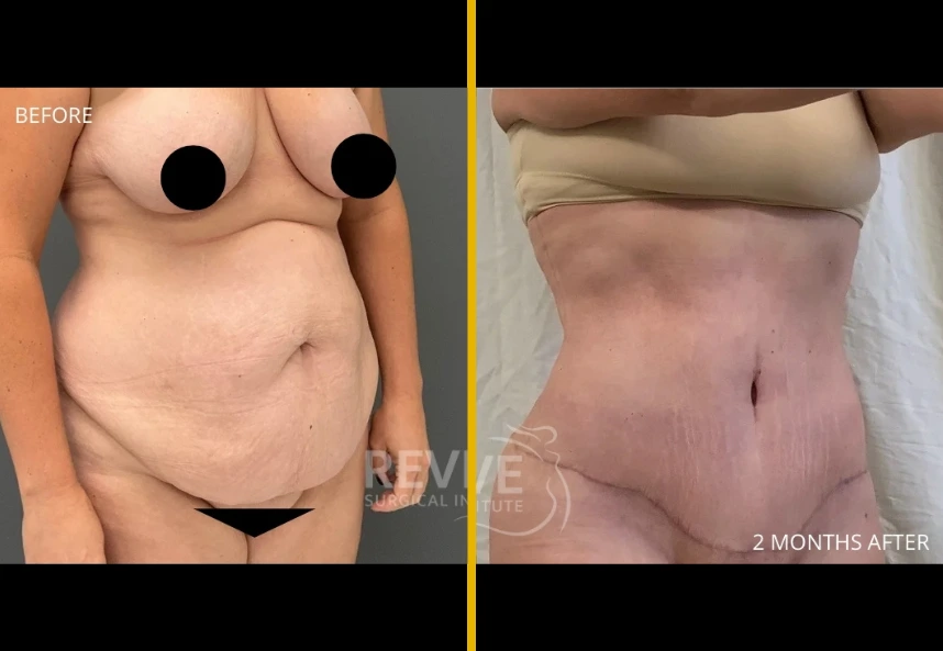 Before and after X-lift treatment showing abdominal contouring results at 2 months