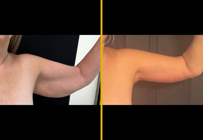 arm-lift-c