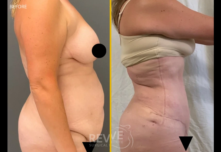 Before and after body contouring surgery, side view