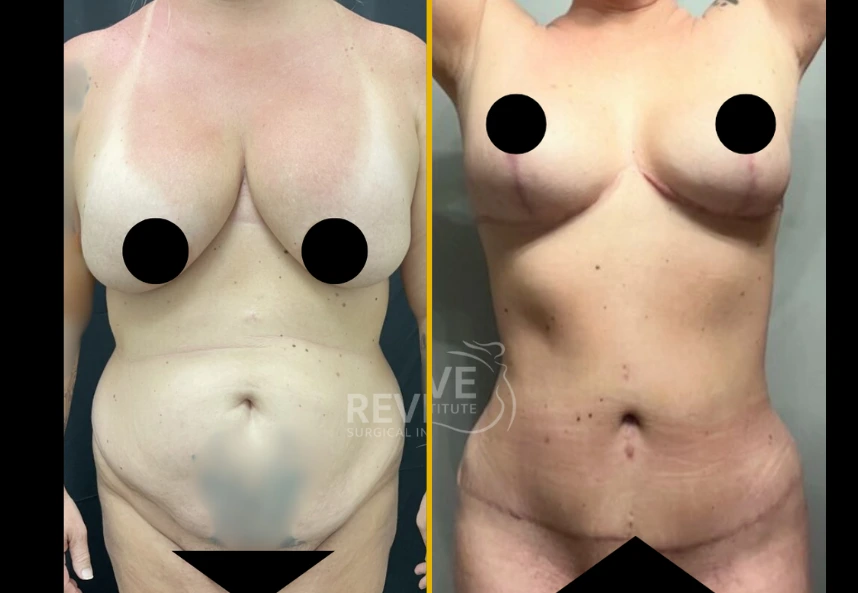 Before and after comparison showing front torso view of body contouring results