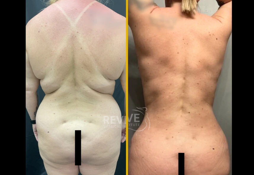 Before and after comparison showing back view of body contouring results