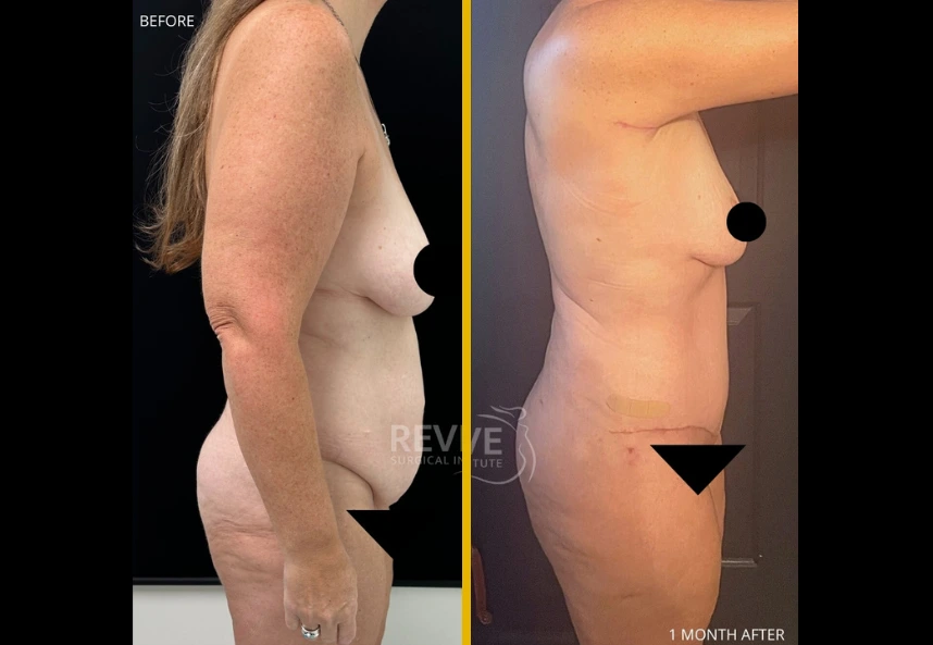 Before and after comparison: left shows side profile before treatment, right shows side profile 1 month after treatment