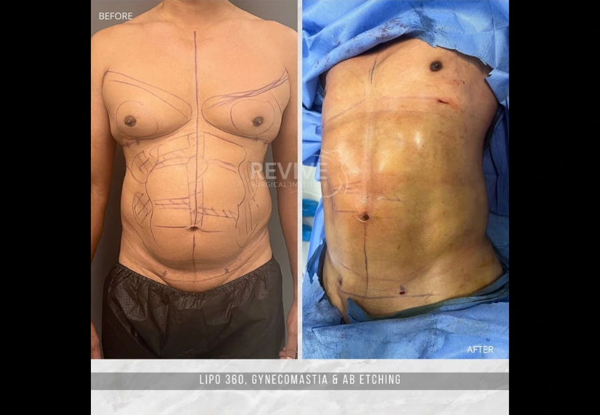 Lipo 360, Gynecomastia, Case 06