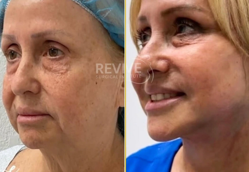 Face, Neck Lift 14