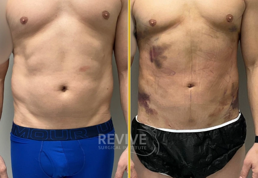 Lipo 360 008