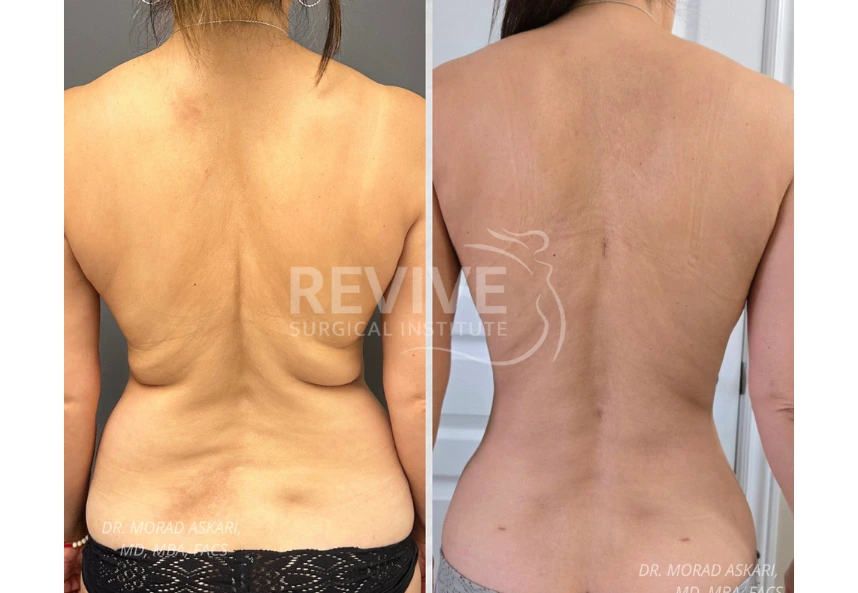 ReviveXlift (5)