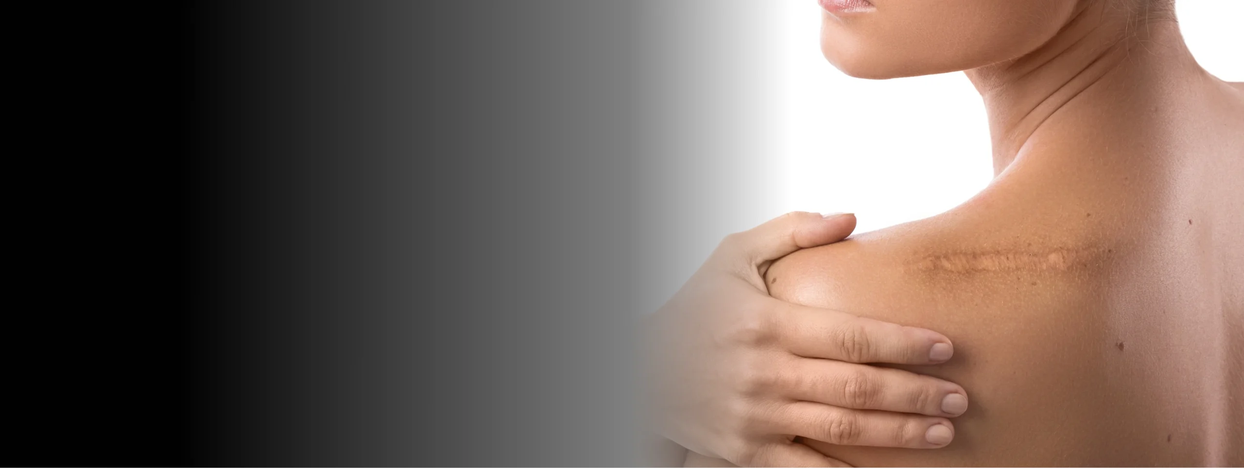 Keloid Scar Treatment in Miami, FL Banner