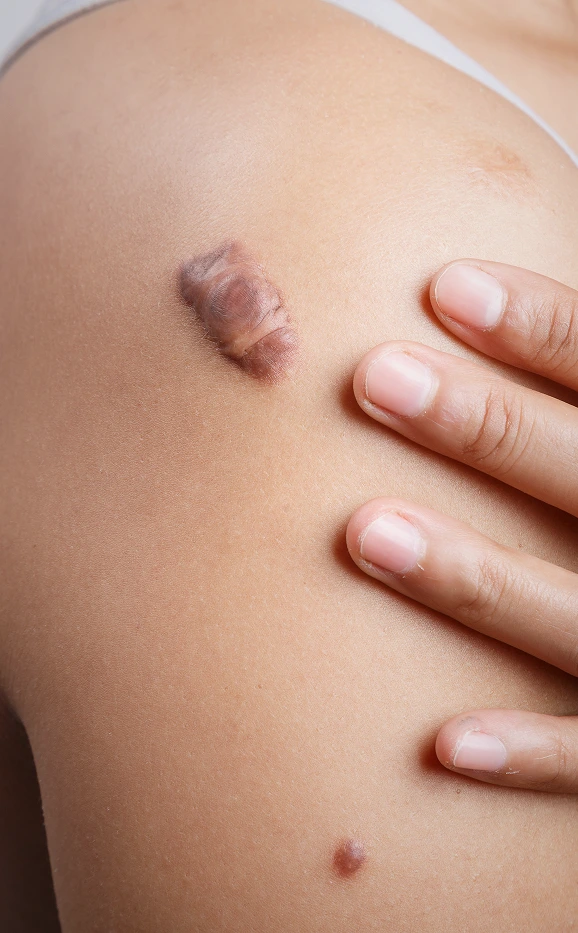 Recovery After Keloid Removal Treatment in Miami, Florida Banner