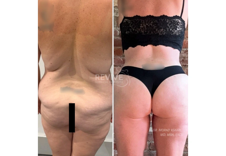 ReviveXlift (4)