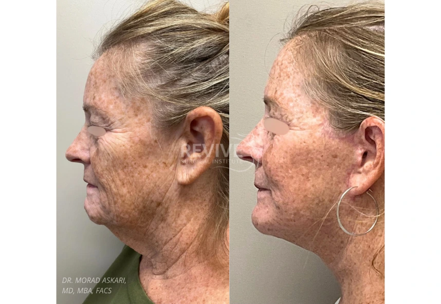 Facelift (2)