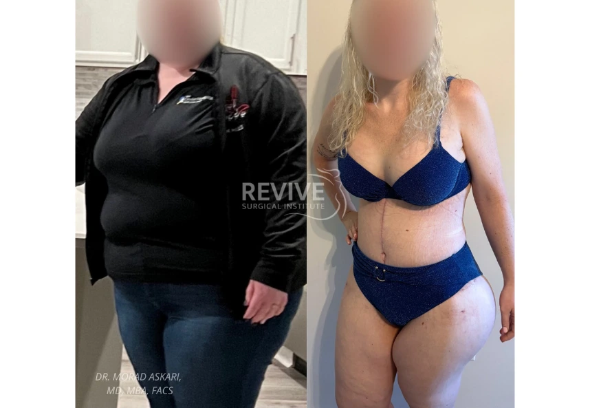 Weight Loss