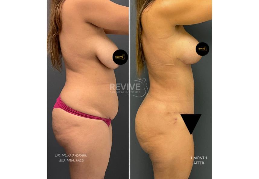 Revive Xlift case76