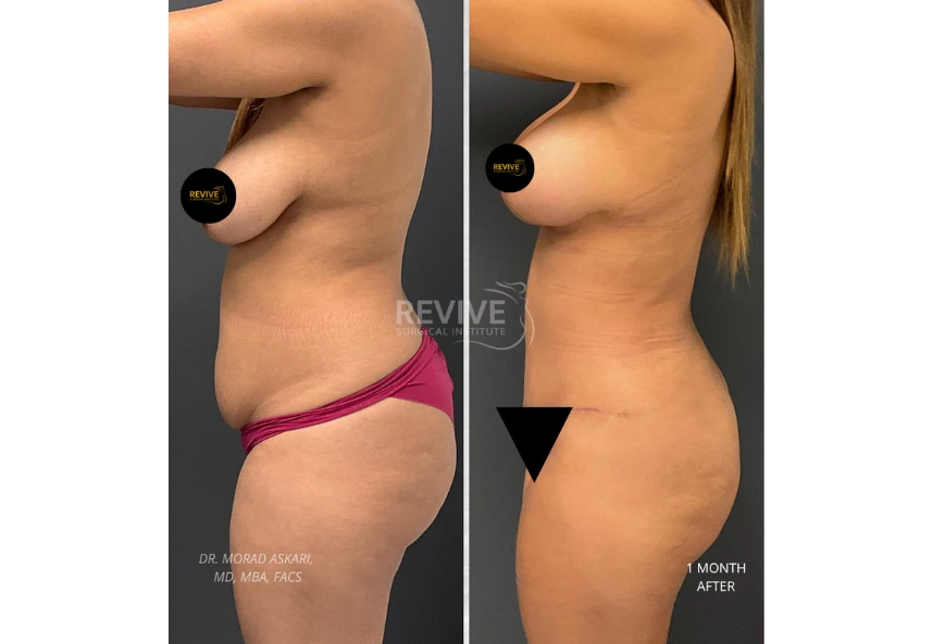 Revive Xlift case77
