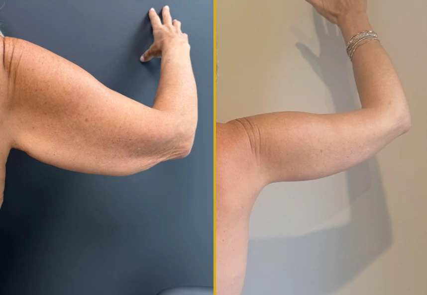 Before and after comparison of arm showing skin tightening results