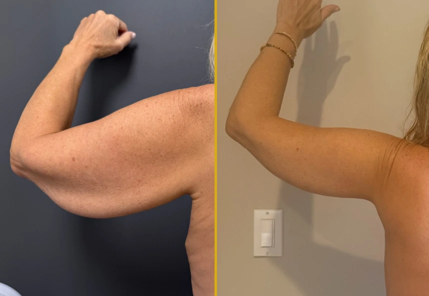 Before and after comparison of arm showing improved skin texture and tone