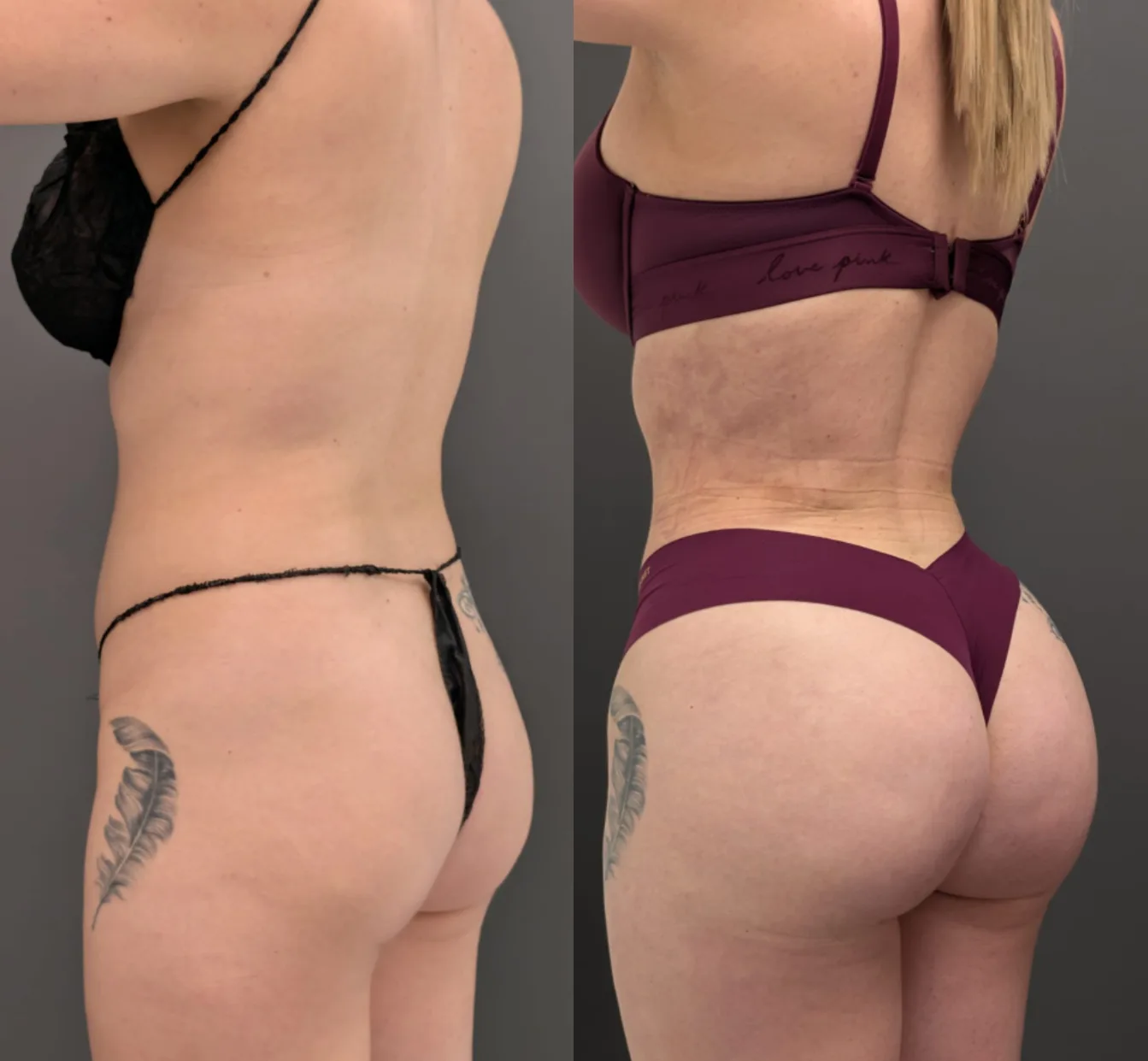 Before and after comparison showing buttock enhancement results from rear view