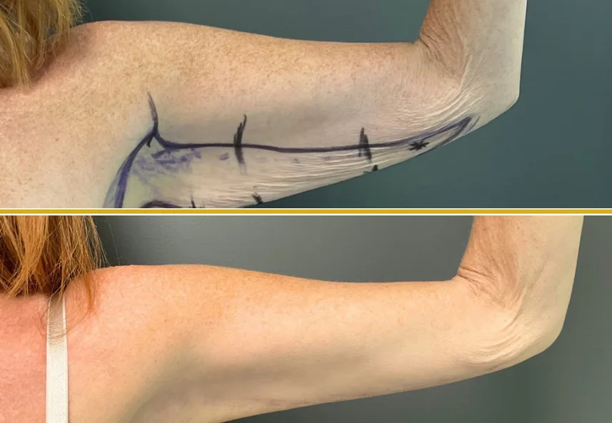 Before and after arm lift surgery showing surgical markings and healed result with reduced loose skin