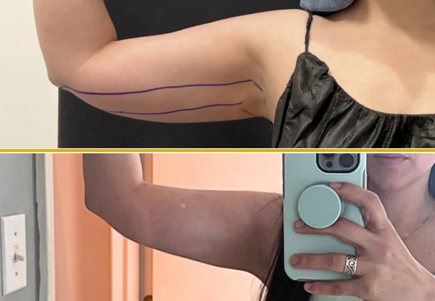 Arm lift surgical planning with incision markings and before and after photos of improved arm contour