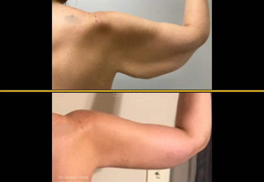 Before and after arm lift results showing improved arm definition and reduced sagging skin