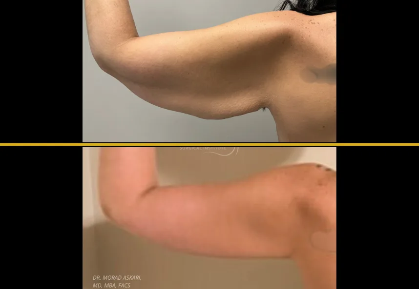 Before and after arm lift comparison demonstrating tightened arm contour and reduced excess skin