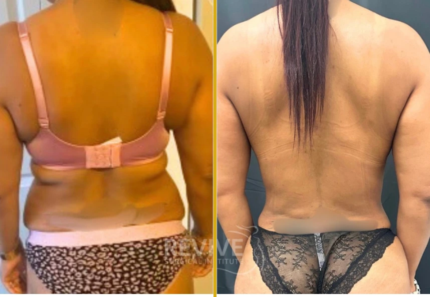 Back liposuction before and after photos showing reduced back fullness and improved body contour