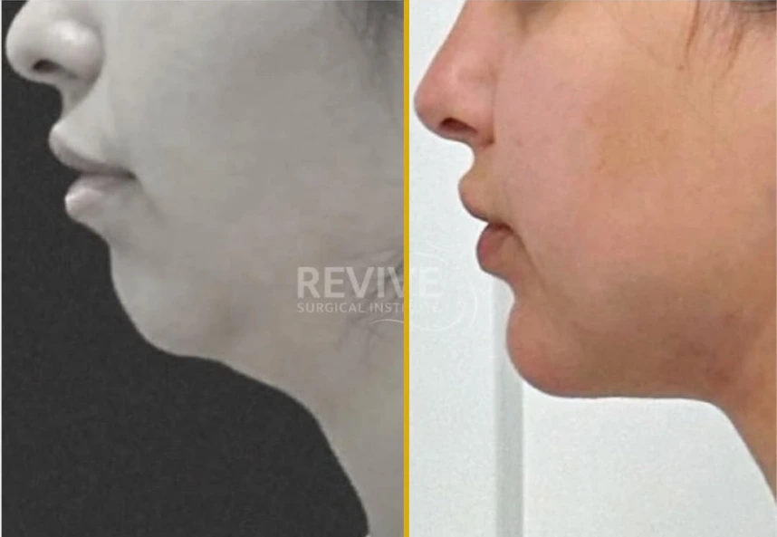 Before and after chin liposuction, left profile with softer jawline, right profile with defined chin contour