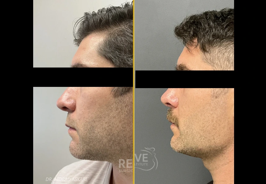 Before and after facial surgery in four views showing profile and frontal angles with refined facial structure