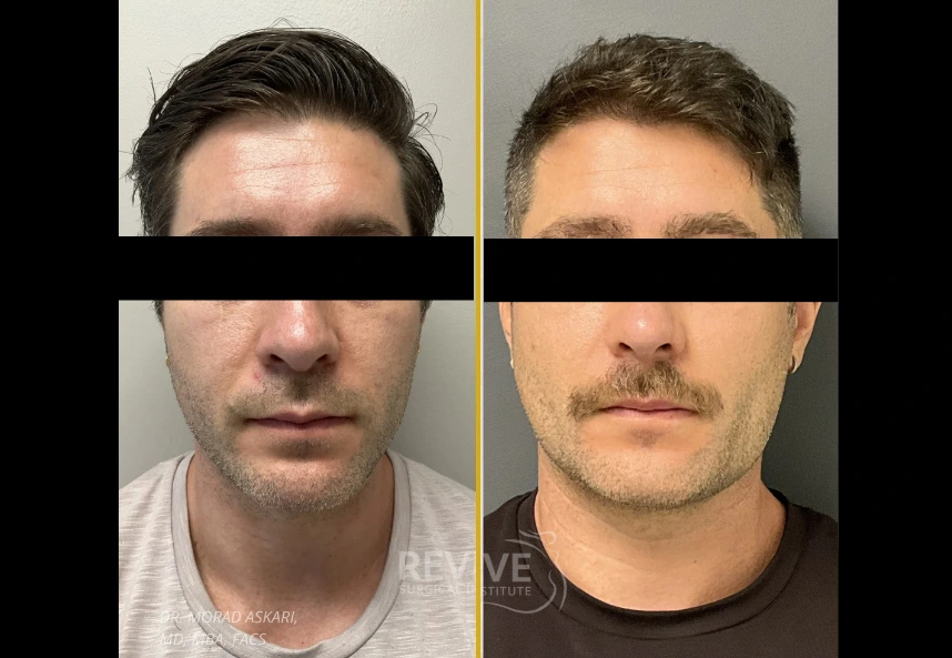 Before and after facial surgery in four views showing forehead, nose, and jawline refinement