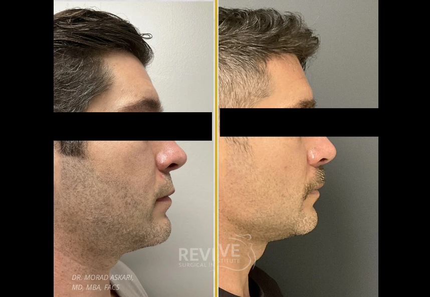 Before and after facial surgery in four views showing profile and angle changes to nose and chin