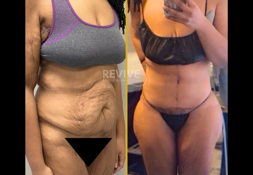 Before and after fleur de lis tummy tuck with vertical abdominal contouring and body reshaping