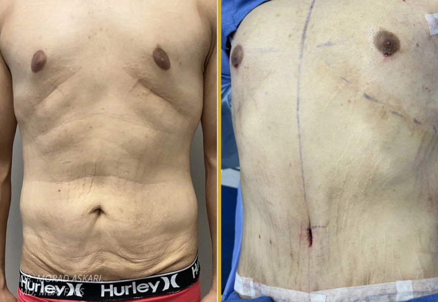 Gynecomastia (4)