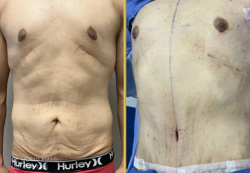 Before and after gynecomastia surgery showing male chest from front angle, left side with enlarged breast tissue, right side with defined pectoral contour and surgical markings