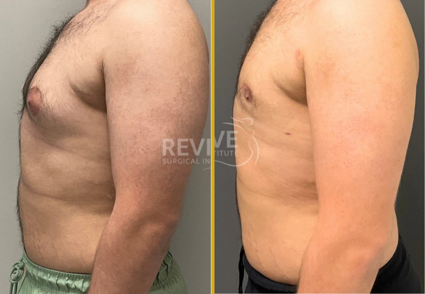 Before and after gynecomastia surgery showing male torso from side angle, left with breast enlargement, right with contoured chest