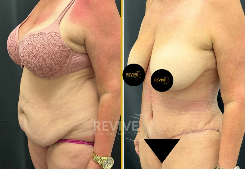 Before-and-after comparison of tummy tuck and breast lift surgery results