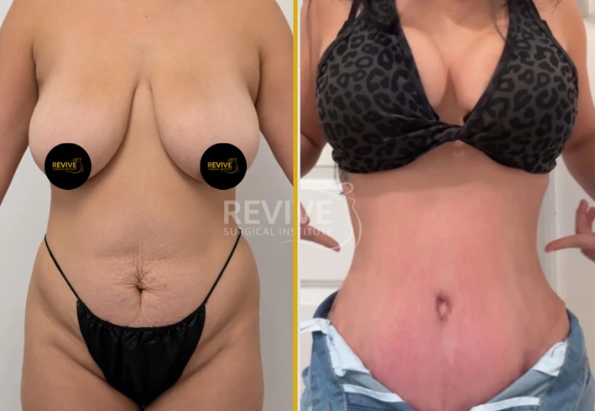 Before and after tummy tuck surgery showing female torso from front, left with loose abdominal skin, right with tightened abdomen in bikini