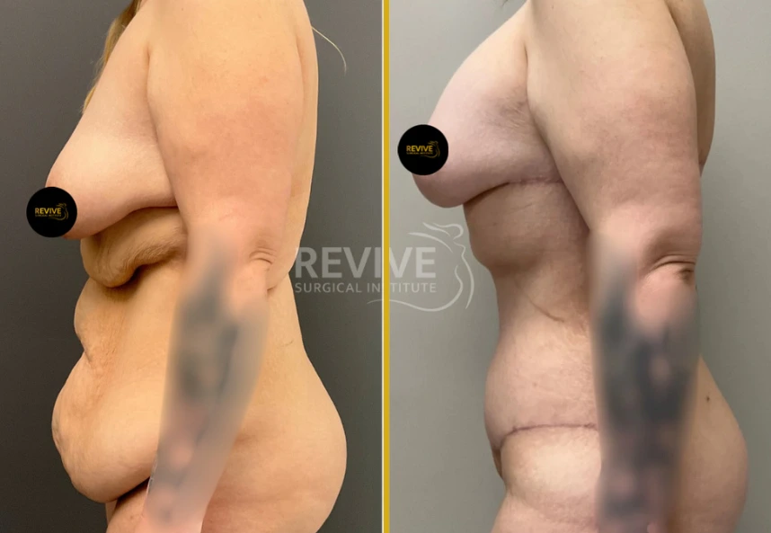 Before and after tummy tuck, back lift, and breast augmentation showing side profile view