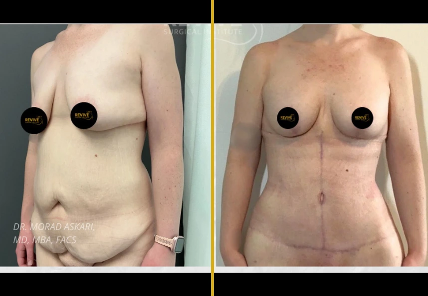 Before and after tummy tuck, breast lift with implant, and back liposuction by Dr. Morad Askari showing side and frontal views
