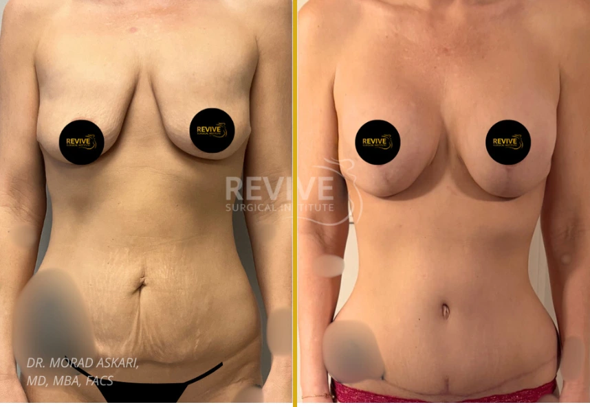 Before and after tummy tuck, breast lift with implant, and back liposuction by Dr. Morad Askari showing frontal torso view