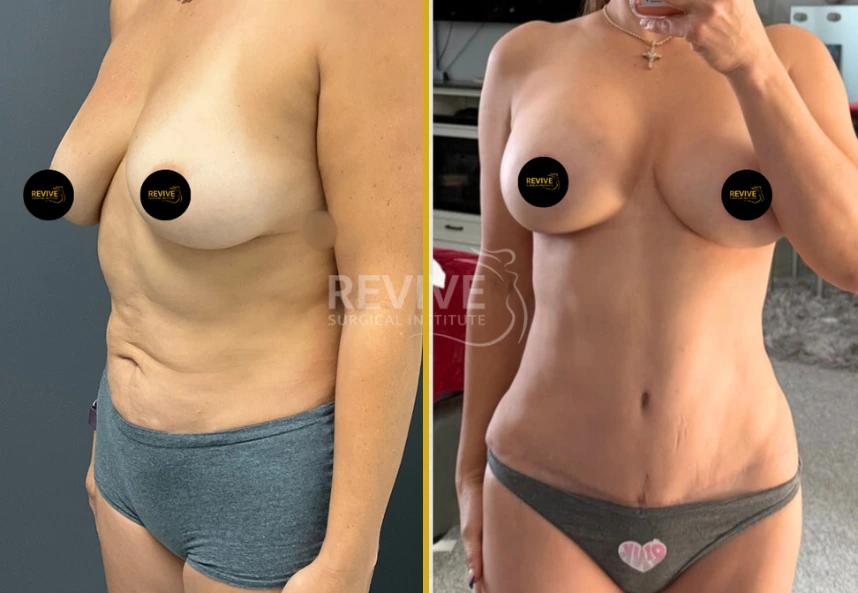 Before-and-after comparison of breast lift with implants and tummy tuck results