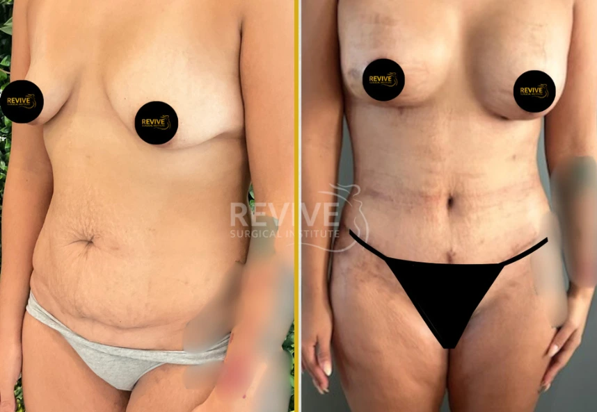 Before and after tummy tuck showing frontal torso view with improved abdominal contour