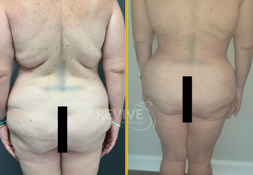 Fleur De Lis Tummy Tuck (2)