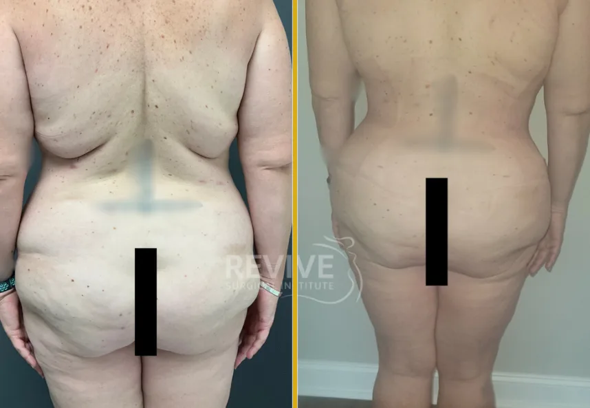 Before and after fleur de lis tummy tuck showing abdominal contouring from rear view